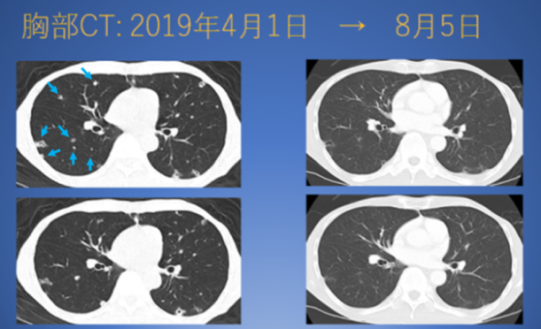 CMI3155-膵がんｰ肺メタ激減-