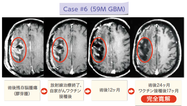 Case #6（ 59M GBM）