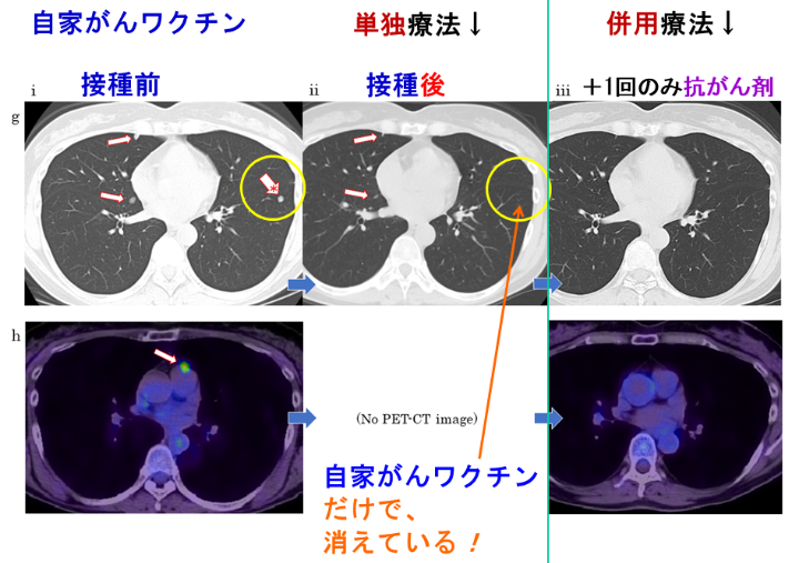 CMI3470-子宮がん多発肺メタ消失-2